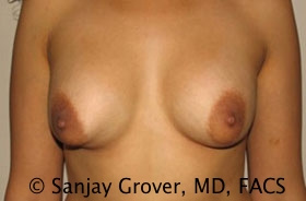 Breast Revision Before and After | Grover Aesthetics