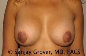 Breast Revision Before and After | Grover Aesthetics