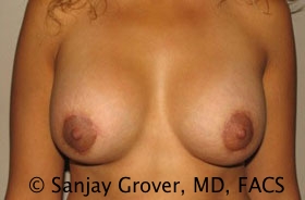 Breast Revision Before and After 39 | Sanjay Grover MD FACS