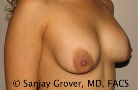 Breast Revision Before and After 39 | Grover Aesthetics