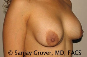 Breast Revision Before and After 39 | Sanjay Grover MD FACS