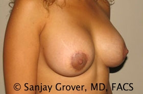 Breast Revision Before and After 39 | Grover Aesthetics