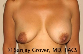 Breast Revision Before and After | Grover Aesthetics