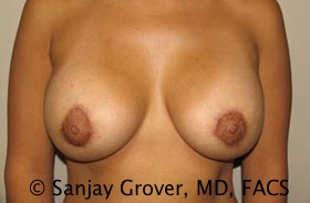 Breast Revision Before and After | Grover Aesthetics