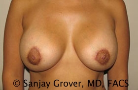 Breast Revision Before and After 40 | Sanjay Grover MD FACS