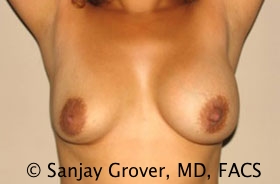Breast Revision Before and After 40 | Grover Aesthetics