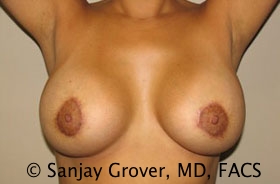 Breast Revision Before and After 40 | Grover Aesthetics
