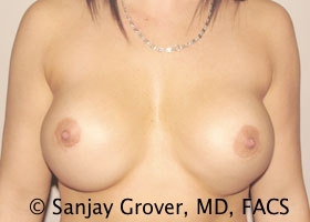 Breast Revision Before and After | Grover Aesthetics