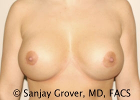 Breast Revision Before and After 41 | Sanjay Grover MD FACS