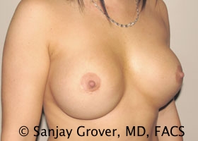 Breast Revision Before and After 41 | Grover Aesthetics