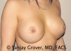 Breast Revision Before and After 41 | Sanjay Grover MD FACS