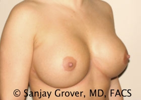 Breast Revision Before and After 41 | Grover Aesthetics