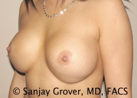 Breast Revision Before and After 41 | Grover Aesthetics