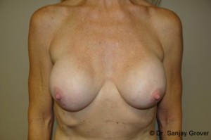 Breast Revision Before and After 25 | Sanjay Grover MD FACS