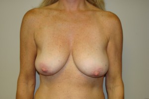 Breast Revision Before and After 22 | Sanjay Grover MD FACS