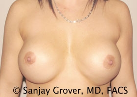 Breast Revision Before and After 11 | Sanjay Grover MD FACS