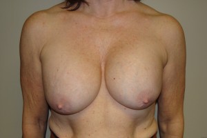 Breast Revision Before and After | Grover Aesthetics