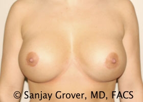 Breast Revision Before and After | Sanjay Grover MD FACS