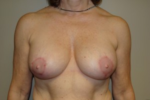 Breast Revision Before and After | Grover Aesthetics