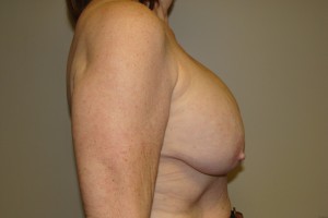 Breast Revision Before and After 44 | Grover Aesthetics