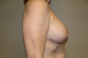 Breast Revision Before and After 44 | Grover Aesthetics