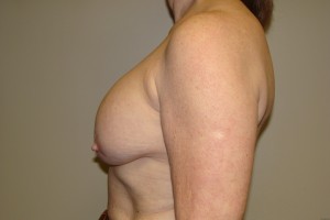 Breast Revision Before and After 44 | Grover Aesthetics