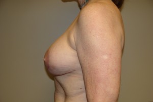 Breast Revision Before and After 44 | Grover Aesthetics
