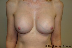 Breast Revision Before and After | Grover Aesthetics