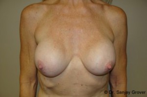 Breast Revision Before and After | Grover Aesthetics