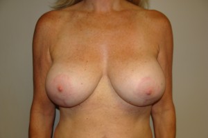 Breast Revision Before and After | Grover Aesthetics