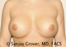 Breast Revision Before and After | Grover Aesthetics