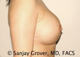 Breast Revision Before and After 49 | Grover Aesthetics