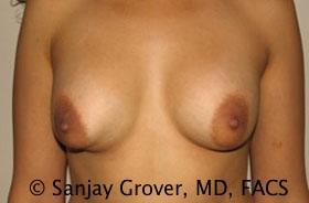 Breast Revision Before and After | Grover Aesthetics