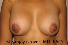 Breast Revision Before and After | Grover Aesthetics