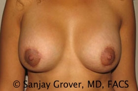 Breast Revision Before and After 50 | Sanjay Grover MD FACS