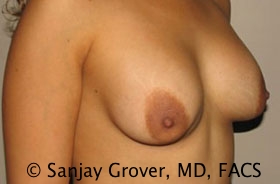 Breast Revision Before and After 50 | Grover Aesthetics