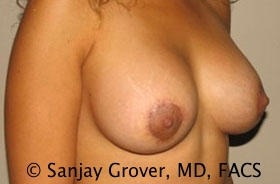 Breast Revision Before and After 50 | Grover Aesthetics