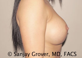 Breast Revision Before and After 50 | Grover Aesthetics