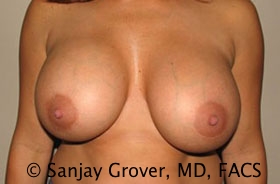 Breast Revision Before and After | Grover Aesthetics