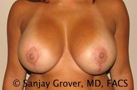 Breast Revision Before and After | Grover Aesthetics