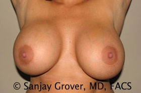 Breast Revision Before and After 51 | Grover Aesthetics