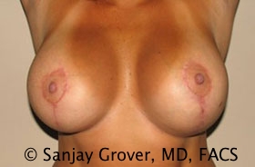 Breast Revision Before and After 51 | Grover Aesthetics