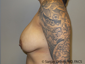 Breast Revision Before and After 60 | Grover Aesthetics