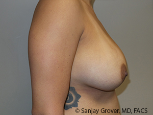 Breast Revision Before and After 60 | Grover Aesthetics