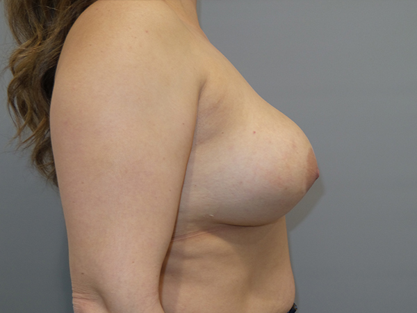 Breast Revision Before and After 61 | Grover Aesthetics
