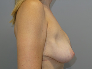 Breast Revision Before and After 62 | Grover Aesthetics