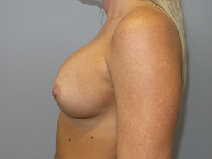 Breast Revision Before and After 64 | Grover Aesthetics