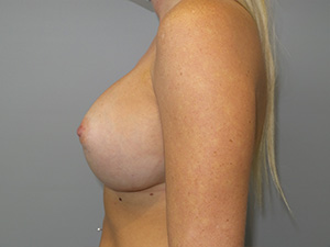 Breast Revision Before and After 64 | Grover Aesthetics