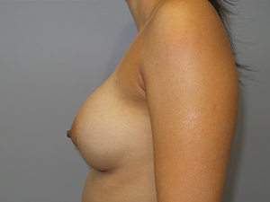 Breast Revision Before and After 65 | Grover Aesthetics