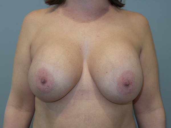 Breast Revision Before and After | Grover Aesthetics